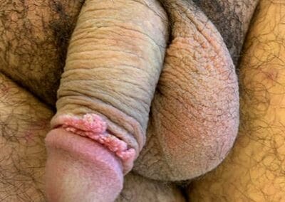 Feigwarze oder Codylomata acuminata durch HPV Entz&uuml;ndung auf dem Vorhaut, anders genannt Condylomata acuminata-Feigwarzen-Feuchtwarzen-Genitalwarzen-Condylox-Aldera-Nd-YAG Laser-Elektrokoagulation-HPV-Dr. Aref Elseweifi-Berlin