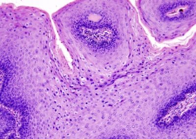 Condylomata acuminata-Feigwarzen-Feuchtwarzen-Genitalwarzen-Condylox-Aldera-Nd-YAG Laser-Elektrokoagulation-HPV-Histologisches Bild-Dr. Aref Elseweifi-Berlin