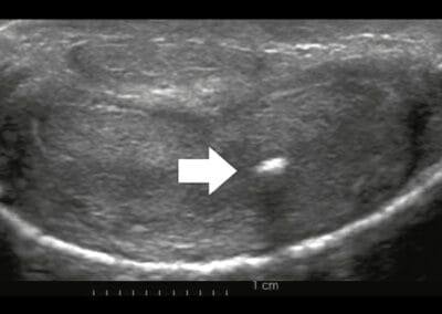 Penisverkruemmung-Penisdeviation-Peniskurve-Morbus Peyronie-Induratio Penis Plastica-IPP-Schwellkoerperverhaertung-Penisaufrichtung-Penisbegradigung-Penisprothese-Potenzstoerung-Dr. Aref Elseweifi-Berlin