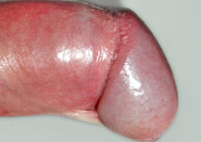 kurze vernarbte weißliche Vorhautbändchen, Frenulum brevae-kurze Penissegel-Frenulumplastik-Frenulotomie-Dr. Aref Elseweifi-Berlin