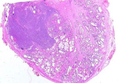 PSMA-PET/CT oder PET/MRI-Adenokarzinom-Anatomie der Prostata-Prostatakrebs-Prostatakarzinom-Prostatageschwulst-Fusionbiopsie-radikale-Prostatektomie-Brachytherapie-Prostata-Vorsorge-Prostatabiopsie-MRI-ICD-10: C61-Ops: 5-604-Dr. Aref Elseweifi-Berlin